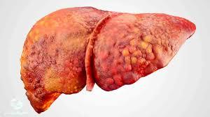 درمان خانگی کبد چرب