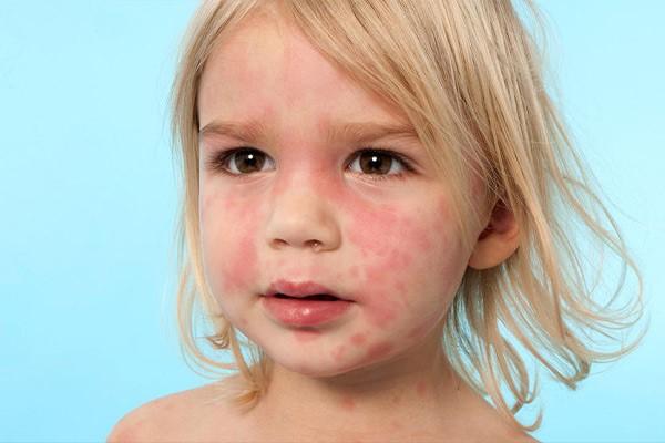 آلرژی پوستی کودکان: علل، علائم و روشهای درمان مؤثر