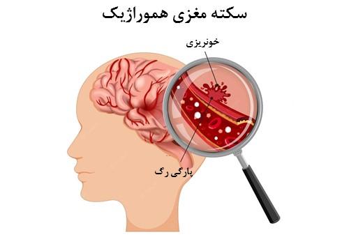اقدامات اولیه برای پیشگیری از سکته مغزی: راهنمای جامع