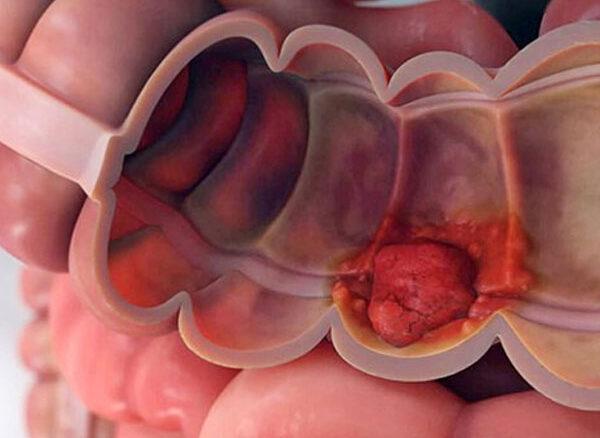 درمان سرطان روده: جدیدترین روشها و راهکارهای موثر